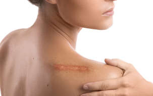 Starostlivosť o jazvy