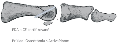 Bioretec ActivaPin - vstrebateľný čap na osteosyntézu